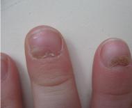 О чем говорит деформация ногтя на большом пальце и мизинце ноги и руки?